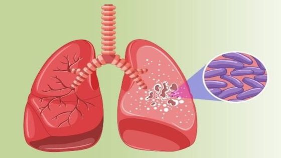 وزارة الصحة والحماية الاجتماعية تعزز جهود الكشف والتكفل بجميع أشكال السل بمناسبة اليوم العالمي لمكافحة السل 2026